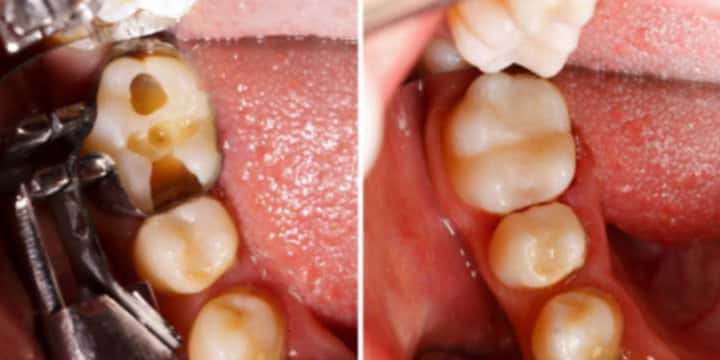 Tooth filling before and after.