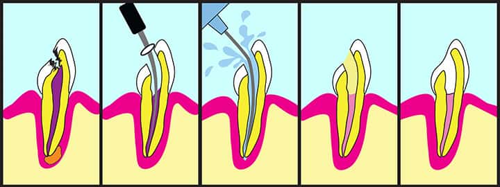Root canal treatment illustrated step by step.